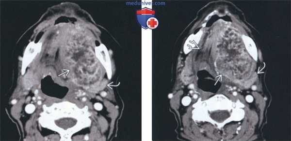 Лучевая диагностика доброкачественной смешанной опухоли подъязычной железы