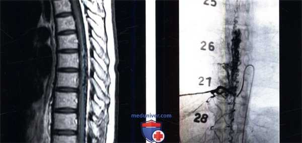 МРТ при сосудистой мальформации 4 типа позвоночника (артериовенозной фистуле, АВФ)