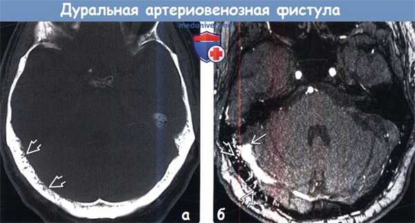Дуральная артериовенозная фистула на КТ, МРТ