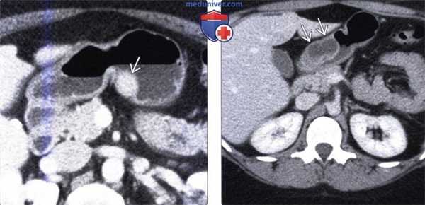 Лучевая диагностика эктопии поджелудочной железы