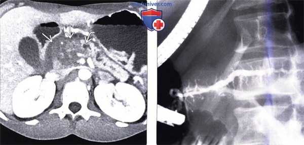 ЭРХПГ, КТ, МРТ, УЗИ признаки хронического панкреатита