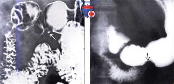 Лучевая диагностика эктопии поджелудочной железы