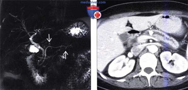 ЭРХПГ, КТ, МРТ, УЗИ признаки хронического панкреатита