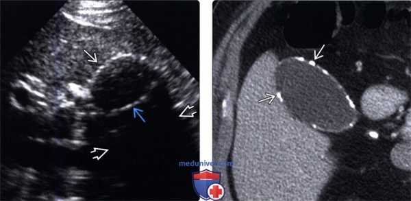 УЗИ при фарфоровом желчном пузыре