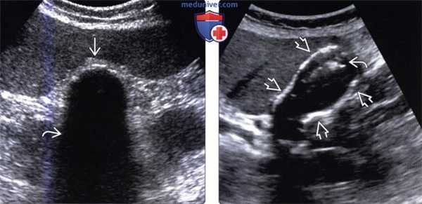 Методы обследования фарфорового желчного пузыря