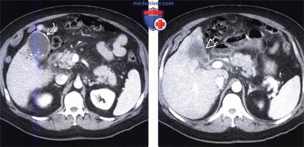 Методы обследования фарфорового желчного пузыря