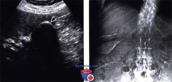 УЗИ при фарфоровом желчном пузыре