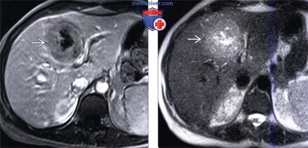 КТ, МРТ, УЗИ признаки воспалительной псевдоопухоли печени