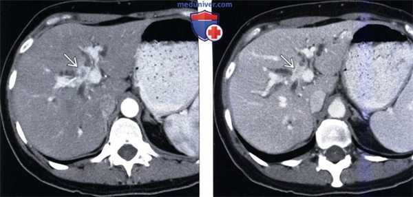 КТ, МРТ, УЗИ признаки воспалительной псевдоопухоли печени