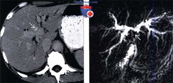 КТ, МРТ, УЗИ признаки воспалительной псевдоопухоли печени