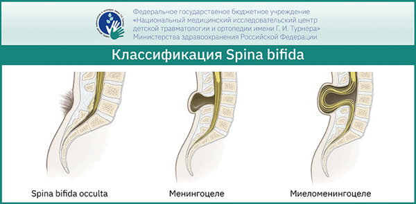 Spina bifida у детей – лечение патологии и особенности заболевания