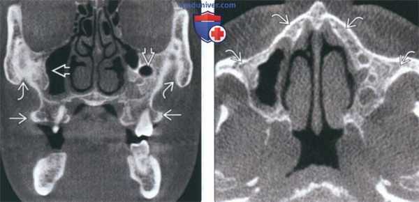 КТ, МРТ при фиброзной дисплазии носа и околоносовых пазух