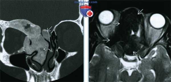 Фиброзная дисплазия пазухи, носа - лучевая диагностика