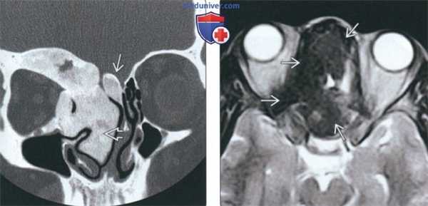 КТ, МРТ при фиброзной дисплазии носа и околоносовых пазух