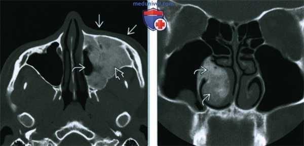Фиброзная дисплазия пазухи, носа - лучевая диагностика