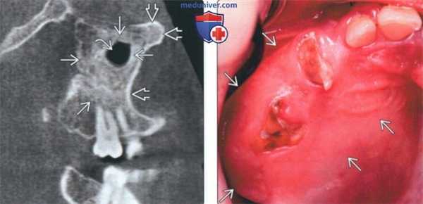 КТ, МРТ при фиброзной дисплазии носа и околоносовых пазух