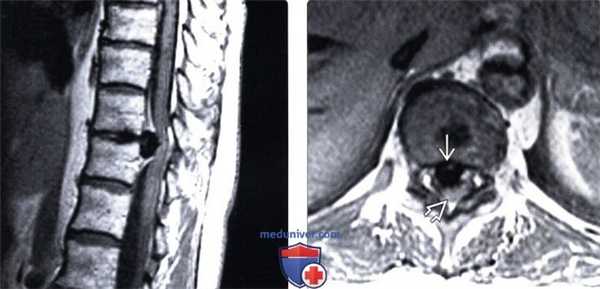 МРТ грыжи межпозвонкового диска грудного отдела позвоночника