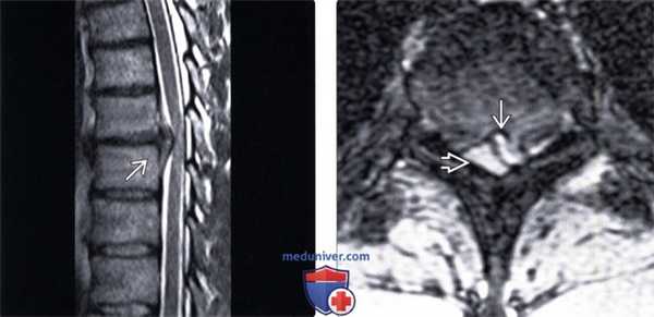 МРТ грыжи межпозвонкового диска грудного отдела позвоночника