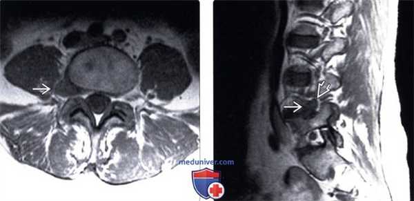 МРТ фораминальной экструзии межпозвонкового диска