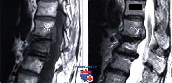 МРТ грыжи межпозвонкового диска грудного отдела позвоночника