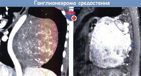 Ганглионеврома средостения на КТ и МРТ