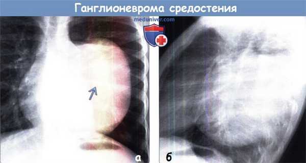 Ганглионеврома средостения на рентгенограмме
