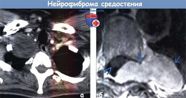 Нейрофиброма средостения на КТ, МРТ