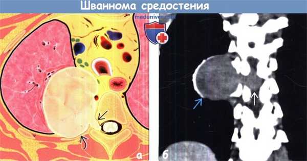Шваннома средостения на КТ