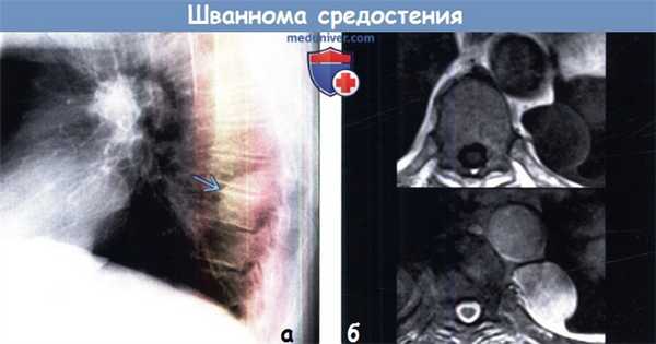 Шваннома средостения на КТ