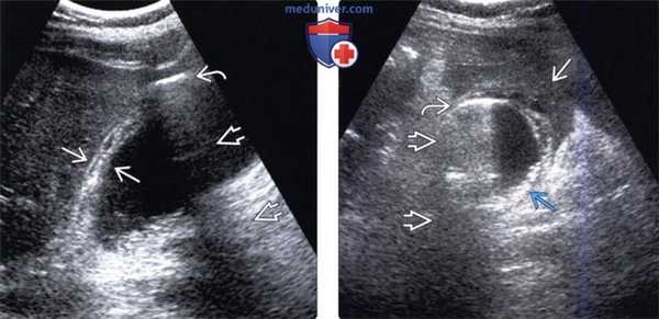 КТ, МРТ, УЗИ признаки эмфизематозного холецистита