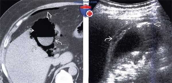 КТ, МРТ, УЗИ признаки эмфизематозного холецистита