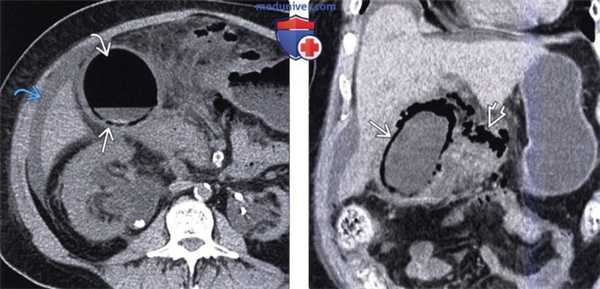КТ, МРТ, УЗИ признаки эмфизематозного холецистита