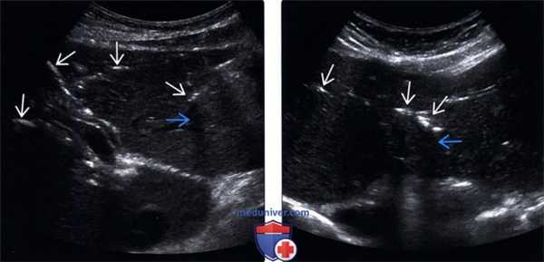 УЗИ при газе в желчных протоках