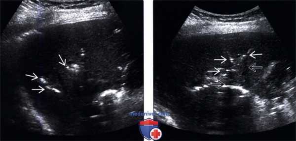 УЗИ при газе в желчных протоках