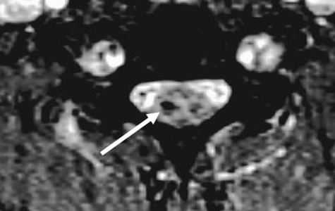 кровоизлияние