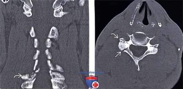 КТ при гиперэкстензионно-ротационном повреждении шейного отдела позвоночника