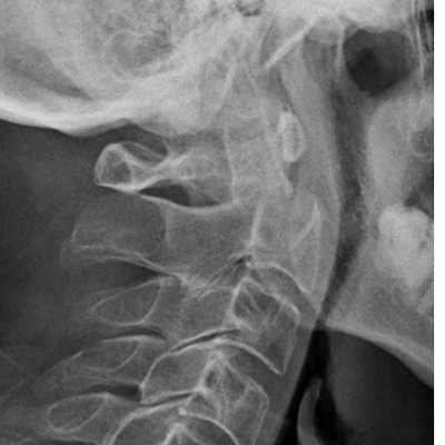 перелом зуба