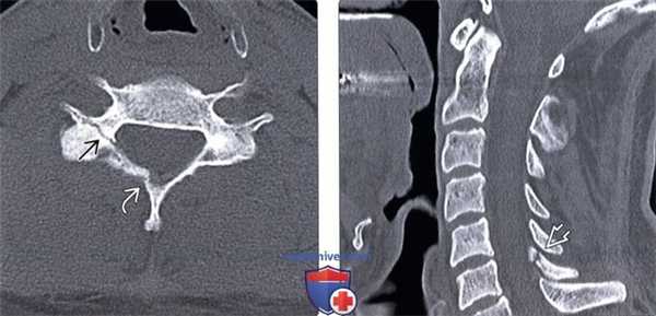 КТ при гиперэкстензионно-ротационном повреждении шейного отдела позвоночника