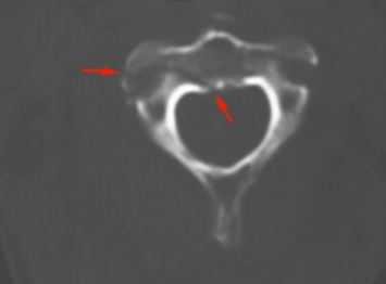 КТ - перелом тела С2