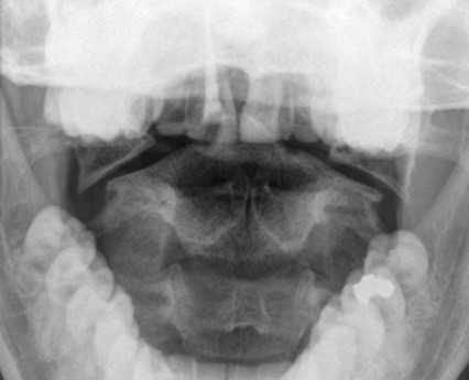 перелом Джеферсона