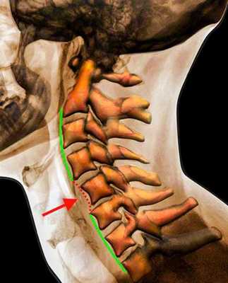 подвывих в шейном отделе в цвете