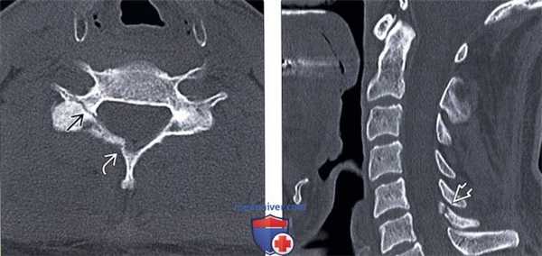 КТ при гиперфлексионно-ротационном повреждении шейного отдела позвоночника
