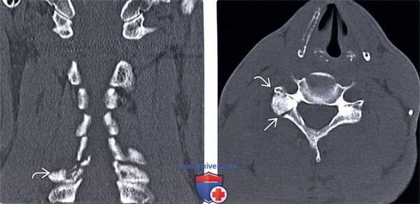 КТ при гиперфлексионно-ротационном повреждении шейного отдела позвоночника