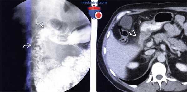 Лучевая диагностика дуоденита