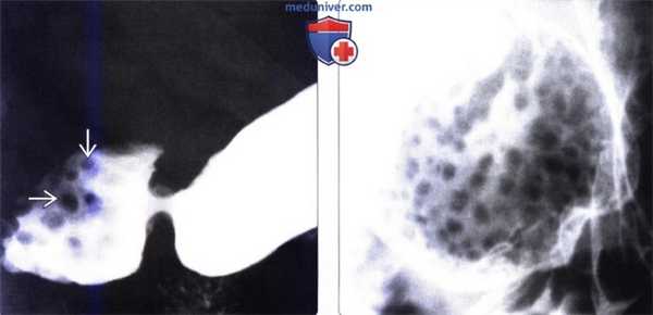 Лучевая диагностика гиперплазии бруннеровых желез