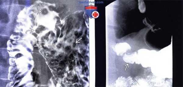 Лучевая диагностика дуоденита