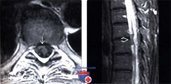 КТ при идиопатической грыже спинного мозга