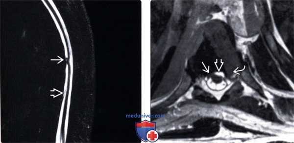 КТ при идиопатической грыже спинного мозга