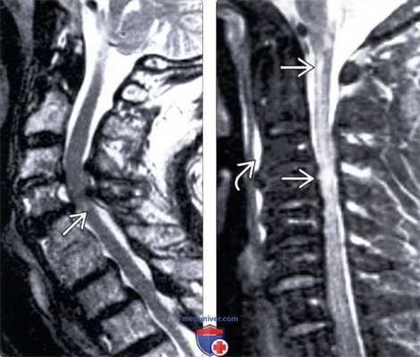 МРТ центрального спинномозгового синдрома