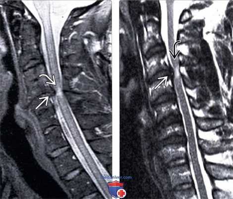 МРТ центрального спинномозгового синдрома